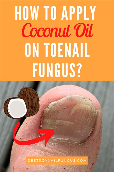 You can use it by itself or you can mix it with essential oils that have the same antifungal and antimicrobial properties. 5 Amazing Ways To Use Coconut Oil For Toenail Fungus