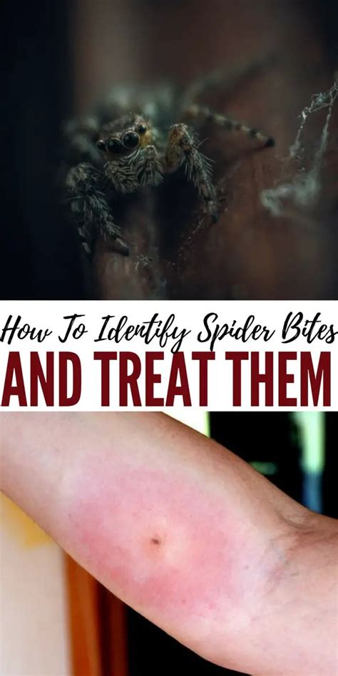 How To Identify A Black Widow Spider Bite