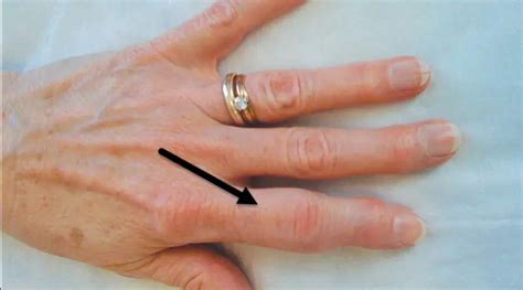 Arthritis In Knuckles Symptoms 5 Warning Signs Body Pain Tips