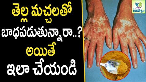 Home Remedies For White Spots On Skin Health Tips In Skin Mana