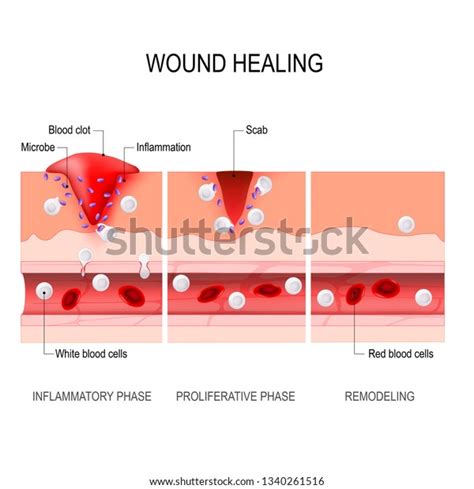 Wound Healing Process Hemostasis Inflammatory Proliferative Stock Vector Royalty Free