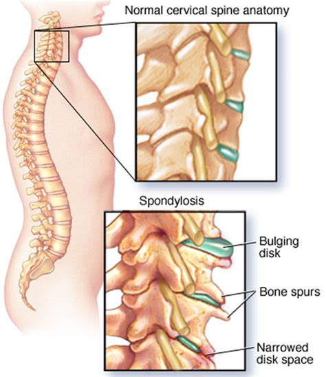 Pinched Nerve In Neck Arm Shoulder Causes Symptoms And Treatment