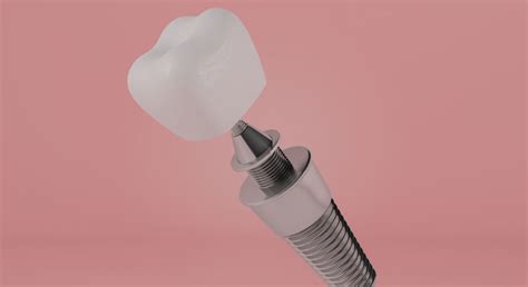 Dent sur pivot quand sont indiqués les pivots dentaires
