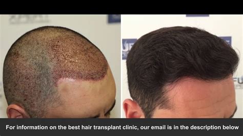 Best Hair Transplant Clinic You Never Knew Existed Youtube