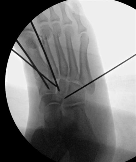 Lisfranc Injury Foot And Ankle Orthobullets