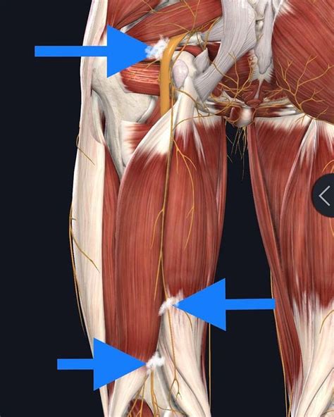 Here Are The 3 Most Common Places For Sciatic Nerve Entrapment