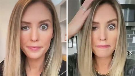 Influencer Reveals Botched Botox Treatment With Shocking Pics