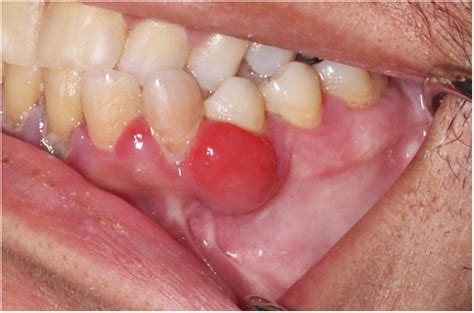 Gingival Swelling And Diffuse Mandibular Osteolysis In A 57 Year Old