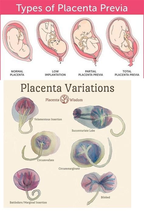 Information about placenta previa, a complication of pregnancy, which main symptom is vaginal bleeding. Placenta variations and what they look like - NCLEX Quiz