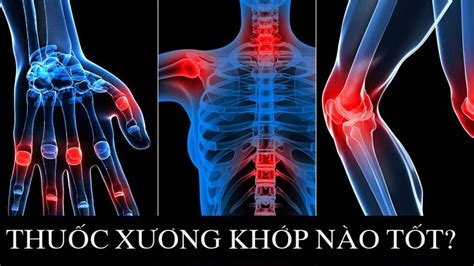 Consider cytokine storm syndromes and immunosuppression lancet. Viêm xương khớp là gì ? Những vấn đề nên biết đến để ngừa ...