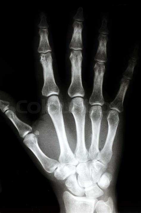 X Ray Of The Right Hand Stock Image Colourbox