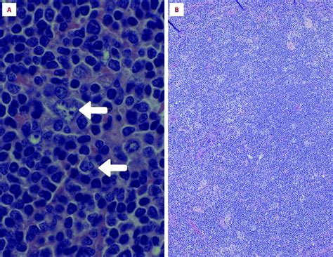 Photomicrographs Of The Histopathology Of The Axillary Lymph Node In A