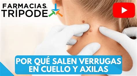 Cómo eliminar verrugas en el cuello Por qué salen verrugas en el