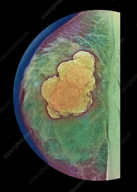 Breast Tumour X Ray Stock Image M1220298 Science Photo Library