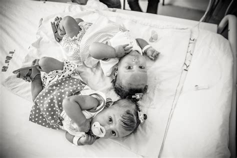 Amazing Photos Celebrate Conjoined Twins Successful Separation Sheknows