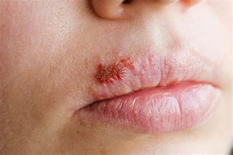 What Are Cold Sores Know The Signs Nabta Health