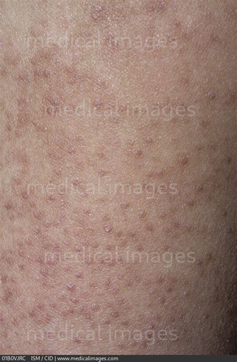 Stock Image Keratosis Pilaris On The Arm Of A Male Patient Close Up