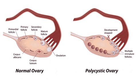 Polycystic Ovarian Syndrome Pcos The Ultimate Guide To Pcos
