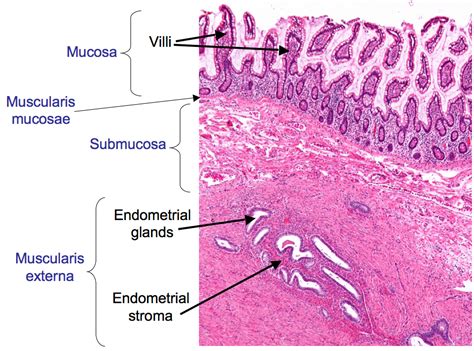 Endometrial Hyperplasia Overgrowth Tissue Endometrium Uterus Stock My