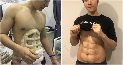 A Hospital In Thailand Is Offering Instant Six Packs Through Plastic
