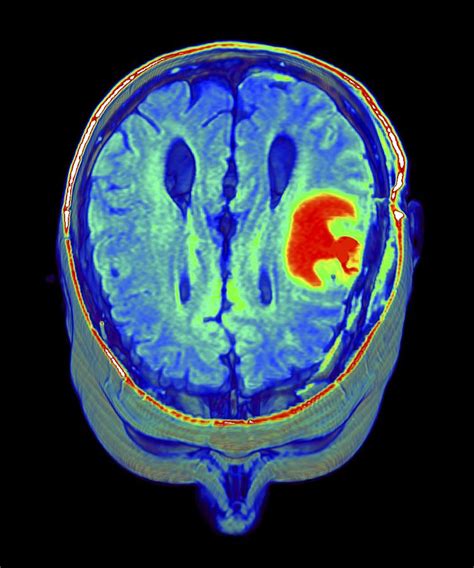 Brain Tumour 3d Mri Scan Photograph By Pasieka Fine Art America