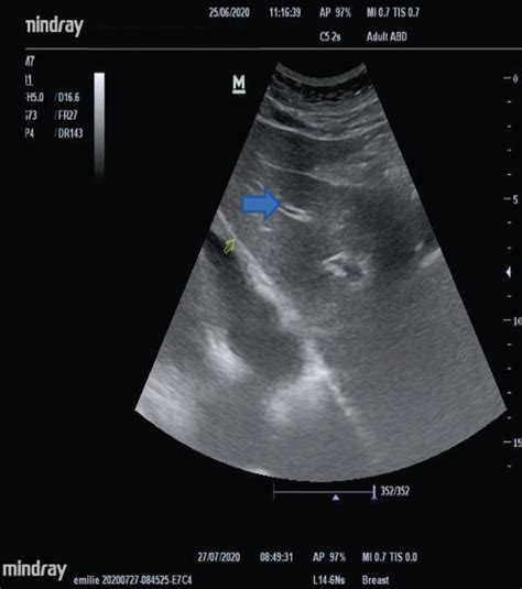A Normal Carotid Artery Ultrasonography High Frequency Probe The
