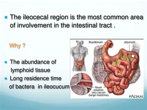 Ppt Intestinal Tuberculosis Powerpoint Presentation Free Download