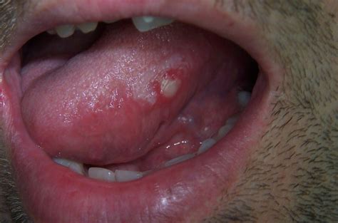 Bumps On Back Of Tongue Causes Large White Red Bumps Remedies And