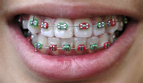 Best Orthodontist And Dentist In Dubai Braces Colors Fake Braces