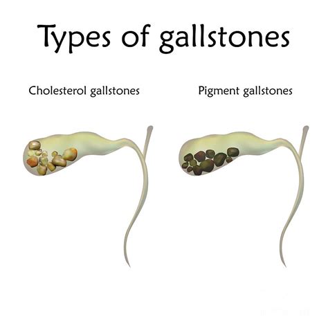 Types Of Gallstones Photograph By Veronika Zakharovascience Photo Library