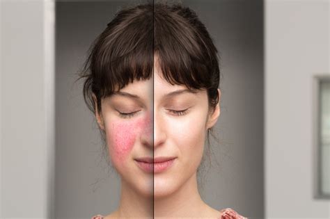 How To Cover Rosacea With Makeup Without Making It Worse Oxygenetix
