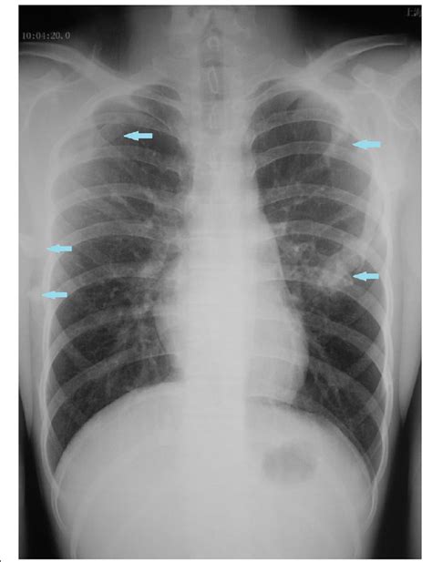 Chest Radiograph Showing Widespread Heterotopic Ossification Along The