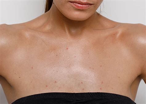 6 Pro Tips To Get Rid Of Chest Acne Raederma