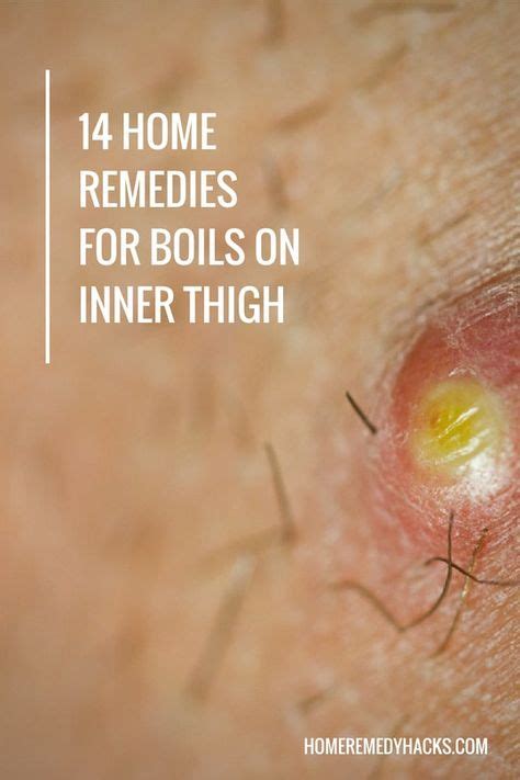 14 Proven Home Remedies For Boils On Inner Thigh With Images Home