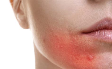 Allergic Rash Joycelim Skin And Laser Clinic