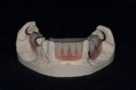 Dentures In Ottawa Partial Dentures