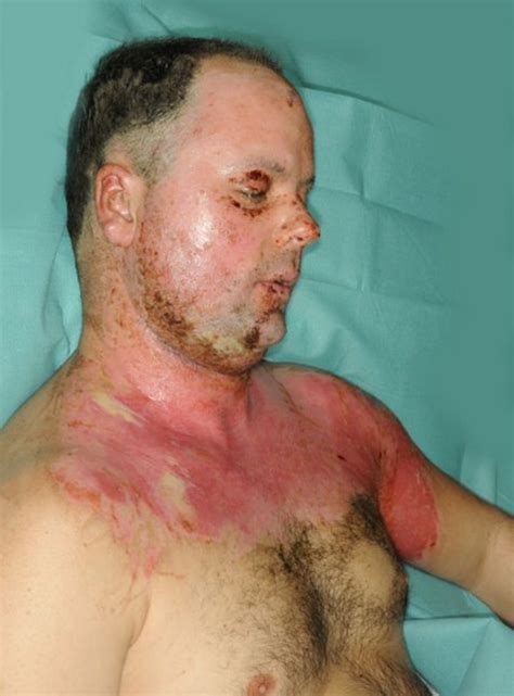 Extra crispy. see, no skin graft here, just pure laser pain. Hydrosurgery-System® in Burn Surgery - Indications and ...