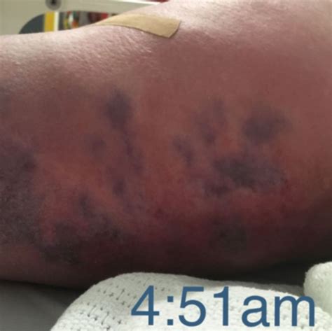 Red ‘bumps On Australian Womans Leg Leads To Necrotising Fasciitis
