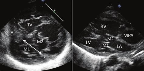 Echocardiograms In Short And Long Axis Of The Heart Showing Straddling