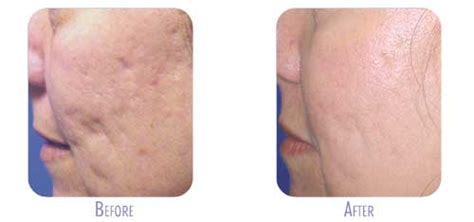 Fraxel Before And After Gallery Bodylase® Med Spa Raleigh And Cary Nc