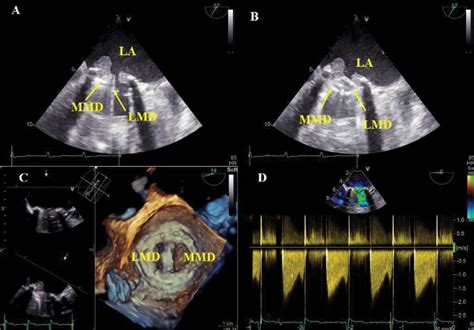 Transesophageal Echocardiography Evaluation Of The Mitral Prosthesis