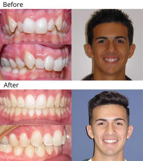 How To Fix A Crooked Smile After Braces Straighten Teeth Without