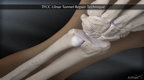 Arthrex TFCC Ulnar Tunnel Repair Technique