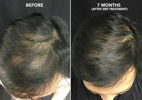 Hair Regrowth Therapy With Acell Prp San Francisco Bay Area Usha