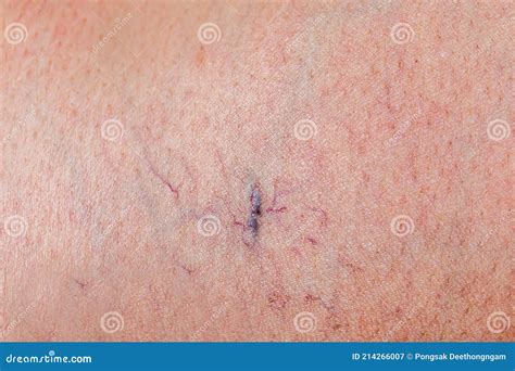 Painful Varicose And Spider Veins On Womans Legs Stock Image Image Of