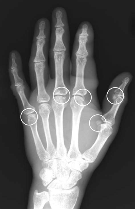 In one subject, the sesamoid bones were found at thumb IPJ and all