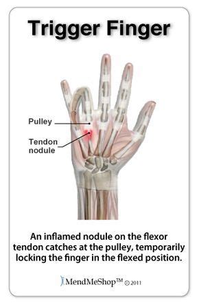 Trigger finger and trigger thumb are painful conditions that cause the