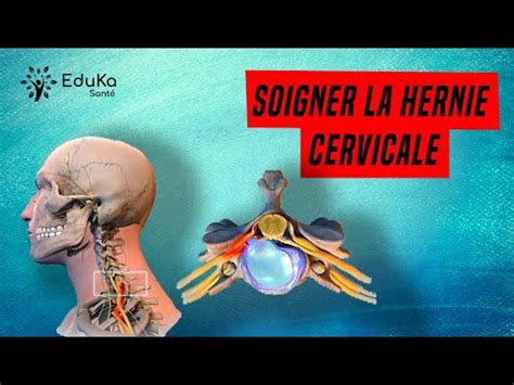 Soigner La Hernie Discale Cervicale Explications Et Exercices