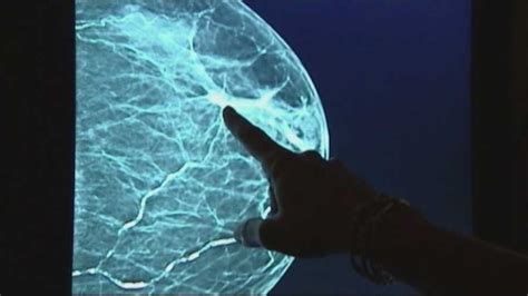 Rare Cancer Linked To Breast Implants Researchers Say