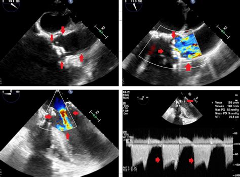 Echocardiographic Assessment Of Aortic Valve Stenosis A Focused Update Hot Sex Picture
